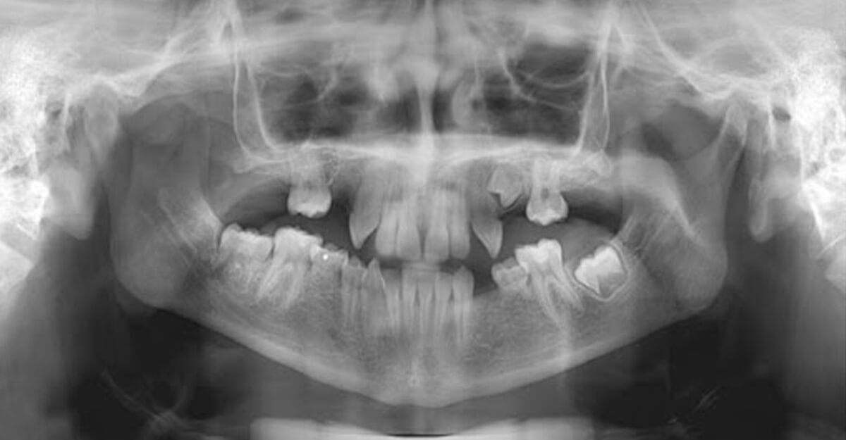 dientes-nunca-salieron